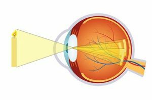 Chirurgie Astigmatisme Clinique Ophtalmologique Tunis
