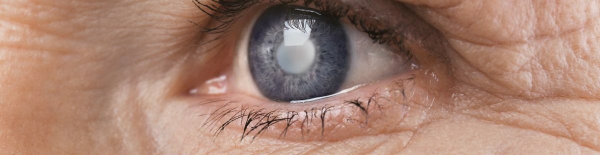 Chirurgie Cataract Clinique Ophtalmologique Tunis Chirurgie Cataract Clinique Ophtalmologique Tunis
