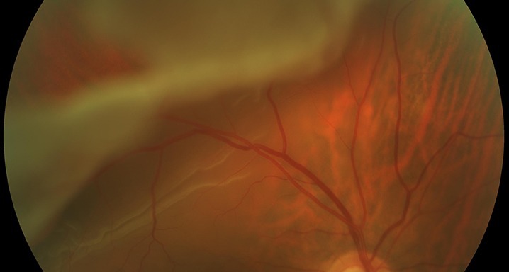 Chirurgie décollement de rétine et Vitrectomie Clinique Ophtalmologique Tunis Chirurgie décollement de rétine et Vitrectomie Clinique Ophtalmologique Tunis