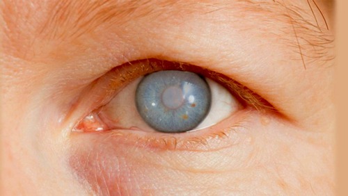 Chirurgie glaucome Clinique Ophtalmologique Tunis Chirurgie glaucome Clinique Ophtalmologique Tunis