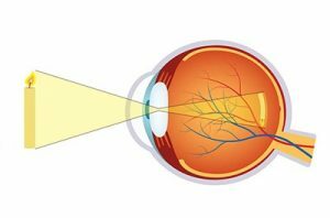 Chirurgie Myopie Clinique Ophtalmologique Tunis