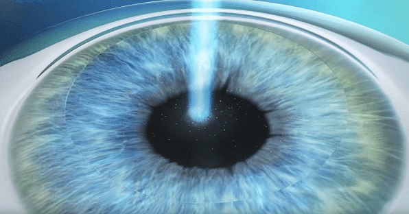 Chirurgie refractive Clinique Ophtalmologique Tunis Chirurgie refractive Clinique Ophtalmologique Tunis